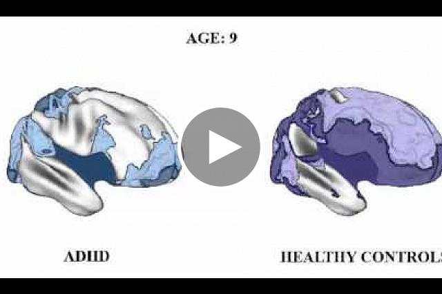 Maturation of the brain, as reflected in the age at which a cortex area attains peak thickness, in ADHD (above) and normal development (below). Lighter areas are thinner, darker areas thicker. Light blue in the ADHD sequence corresponds to the same thickness as light purple in the normal development sequence. The darkest areas in the lower part of the brain, which are not associated with ADHD, had either already peaked in thickness by the start of the study, or, for statistical reasons, were not amenable to defining an age of peak cortex thickness. Movie of same data below. Source: NIMH Child Psychiatry Branch.