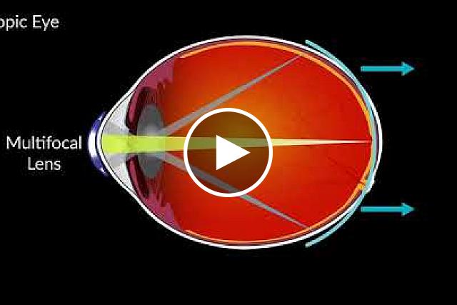 How multifocal contacts can slow the eye growth that causes myopia in children. NEI