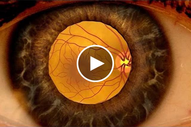 View an NEI video about how diabetic retinopathy can be detected through a comprehensive dilated eye exam