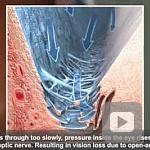 NEI Animation: Glaucoma