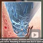 NEI Animation: Glaucoma