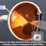 NEI Animation: Diabetic Retinopathy