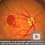 NEI Animation: Age-Related Macular Degeneration (AMD)