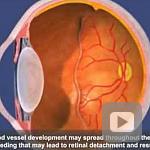 NEI Animation: Retinopathy of Prematurity (ROP)