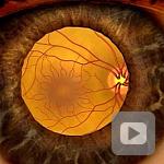 Animation: Detecting diabetic retinopathy through a dilated eye exam